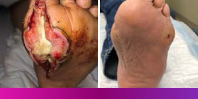 Image of diabetic foot ulcer before and after treatment, taken from the Klein Case Study